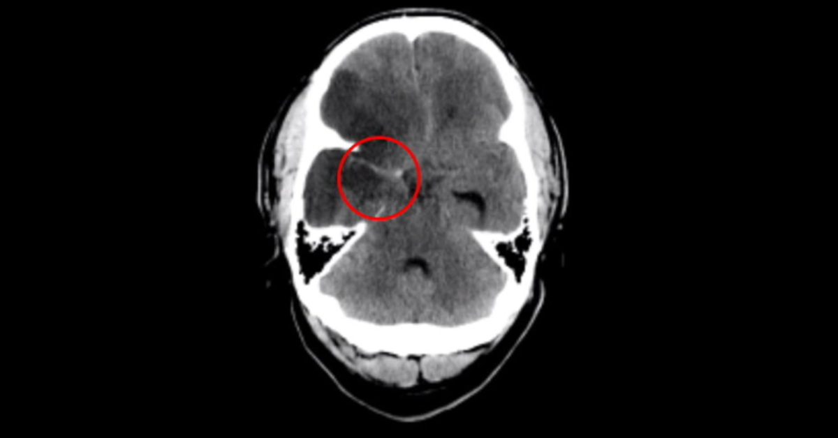 Perfusion Imaging