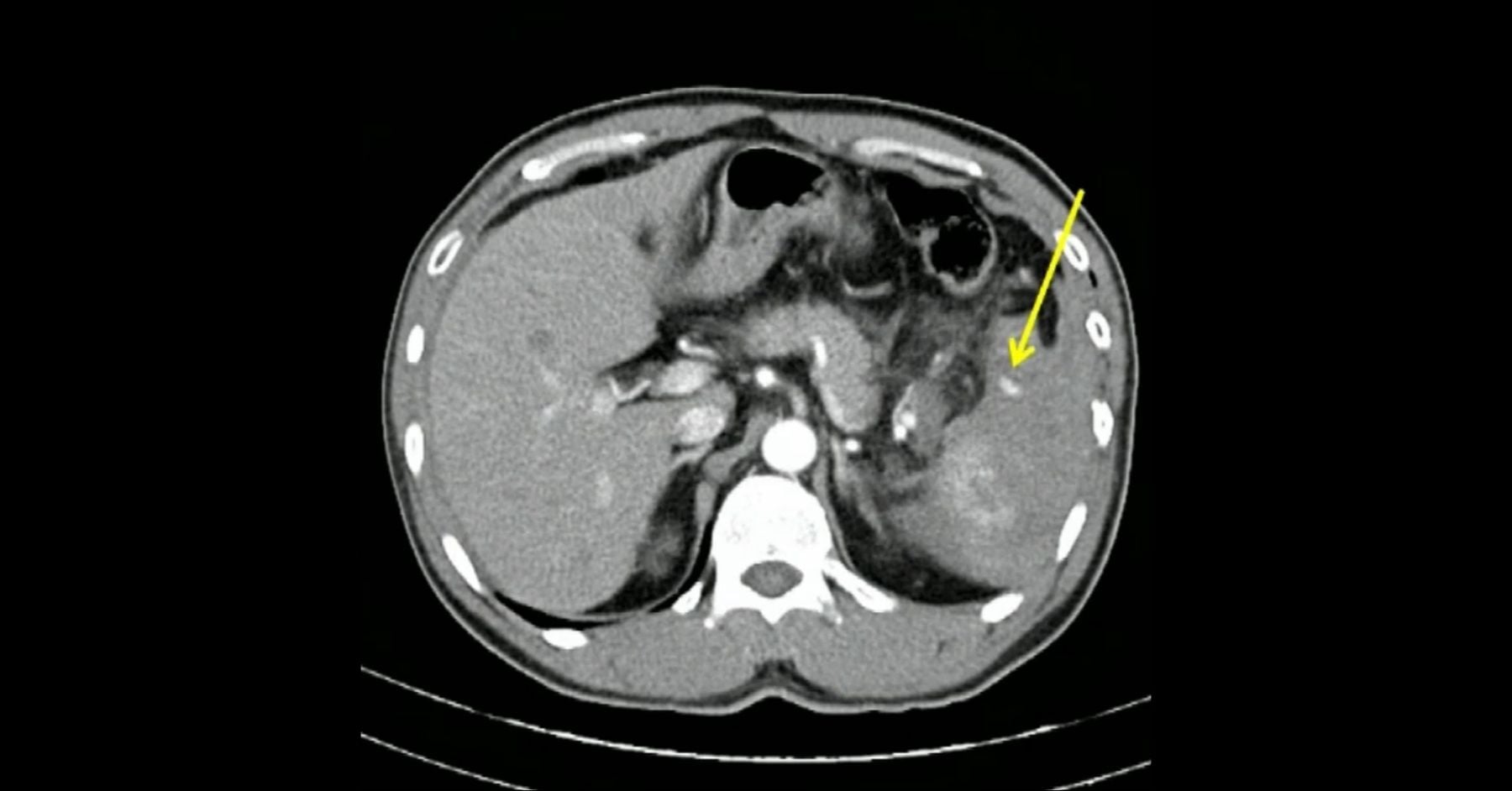 Abdominal Trauma Grading