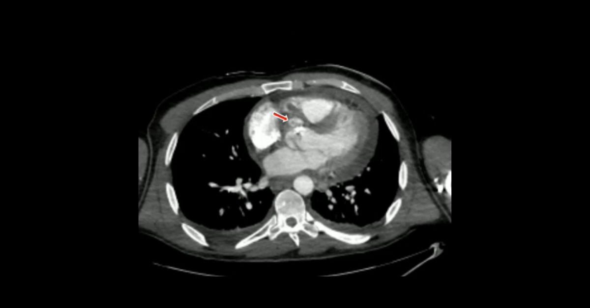 Emergency Cardiac CT: Part 2