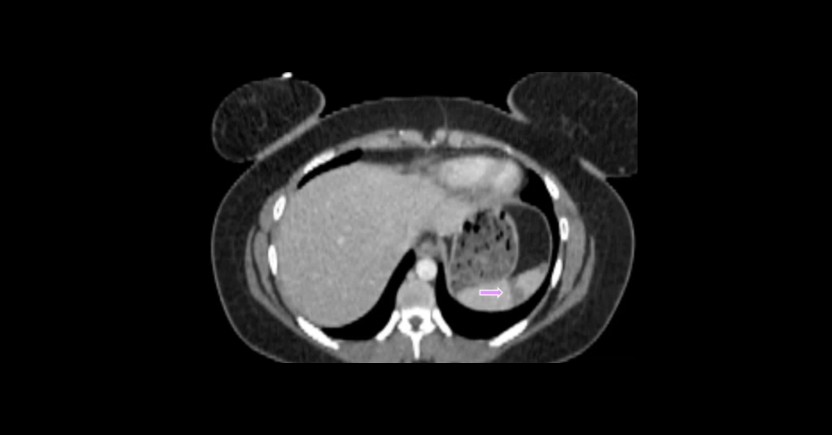 Thoracic Trauma CT: Part 1 (Aorta)