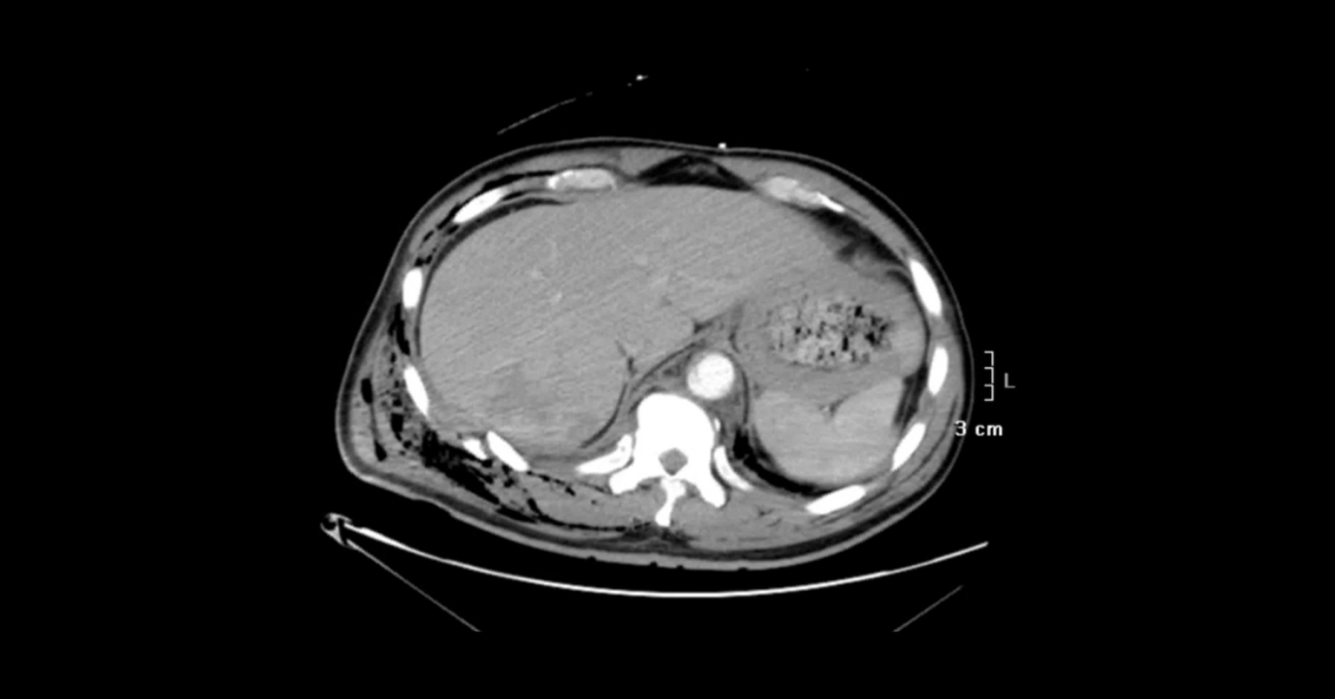 Thoracic Trauma CT Part 2 (Aorta)