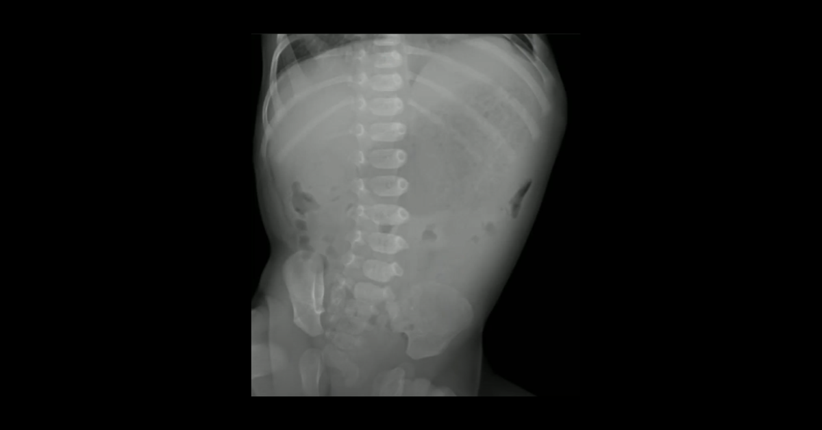 Pediatric Abdominal Emergencies