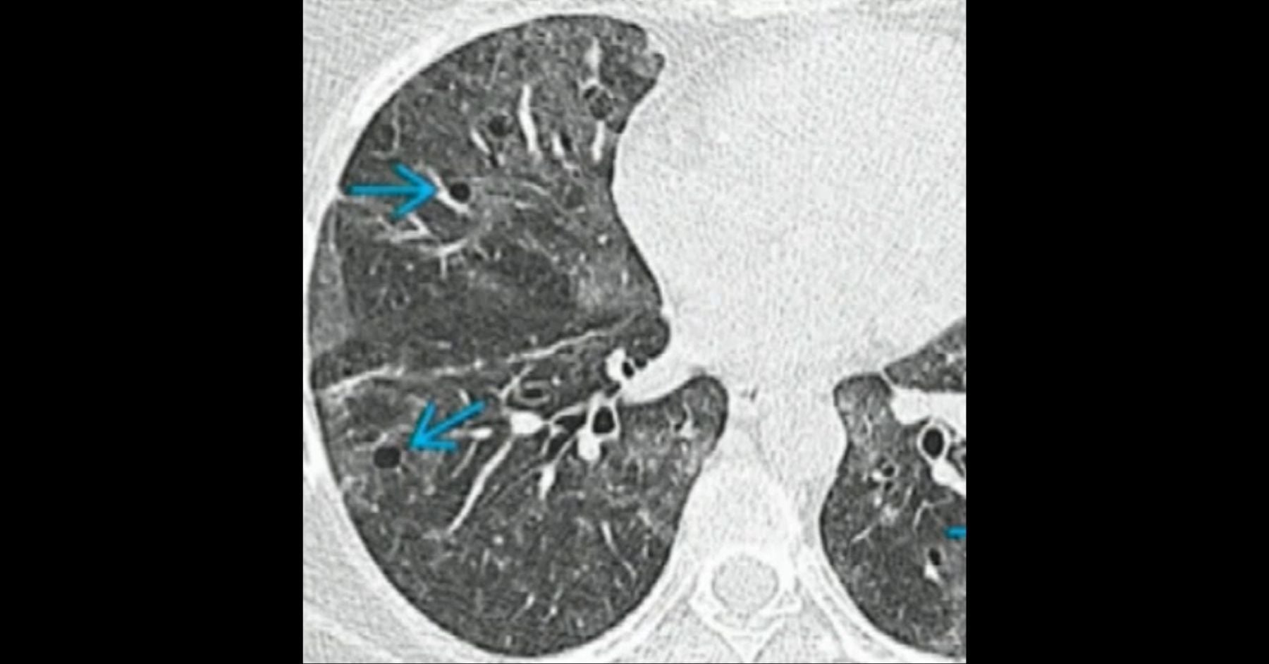 Thoracic Manifestations of Systemic Disease