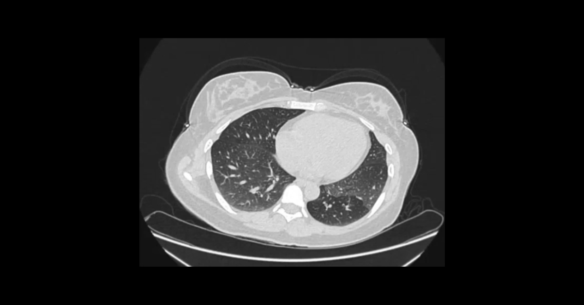 Pulmonary Granulomatous & Cavitary Lesions