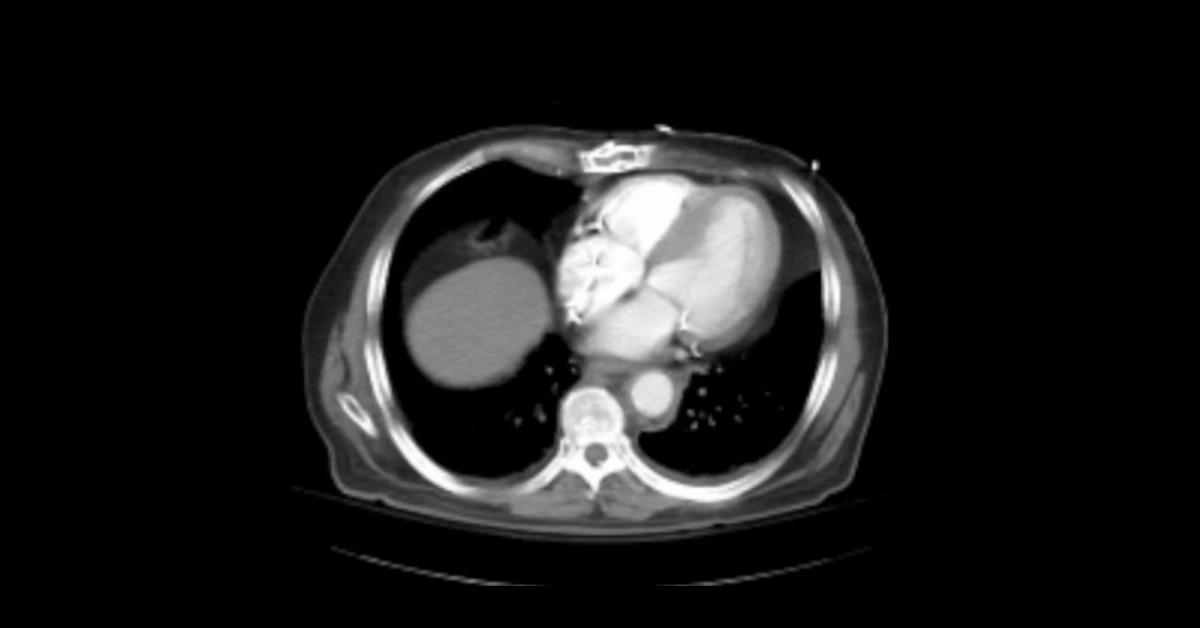 Traumatic Aortic Injuries