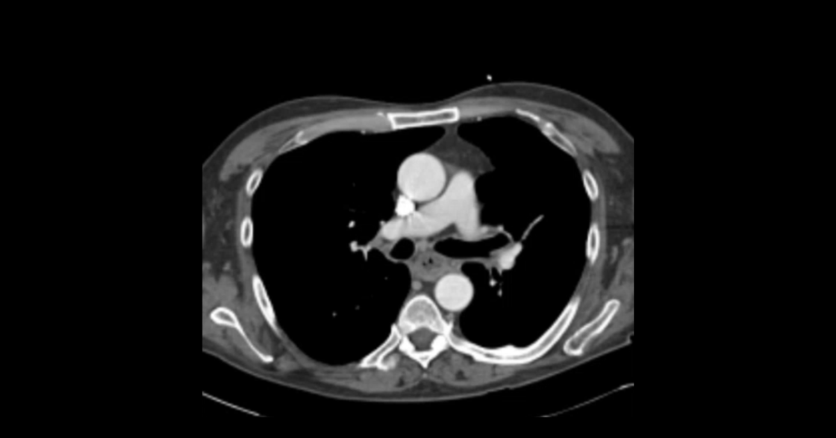 Esophageal Pathology