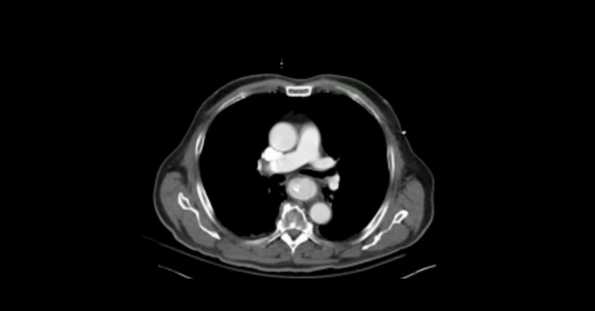 Gastroesophageal Pathology: Perforation, Fistula, & Volvulus