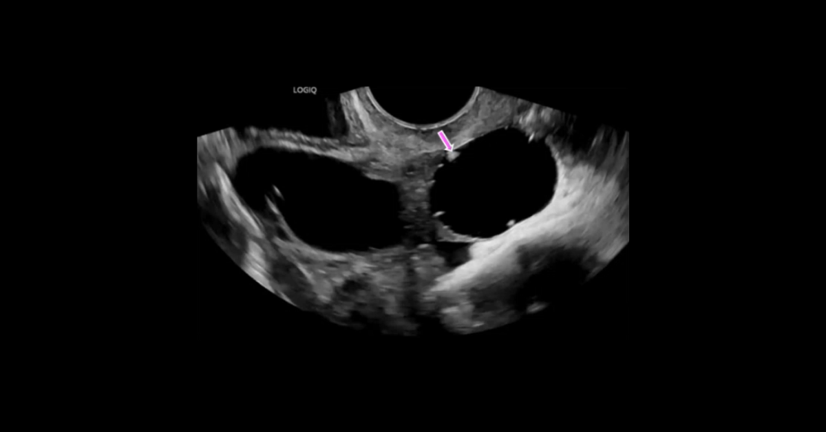 Ultrasound Gynecology