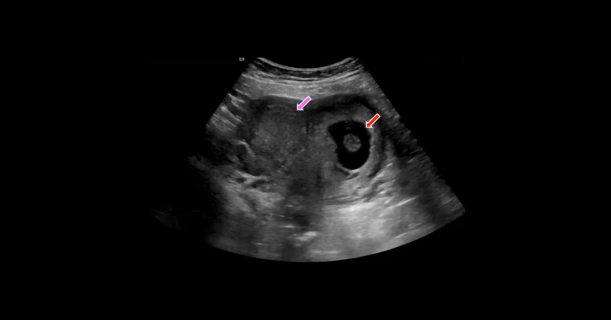Ultrasound of Early Pregnancy