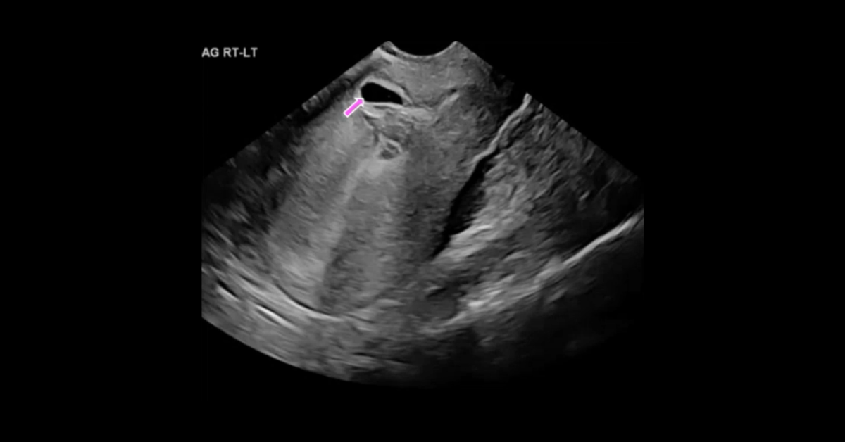 Ultrasound of Later Pregnancy