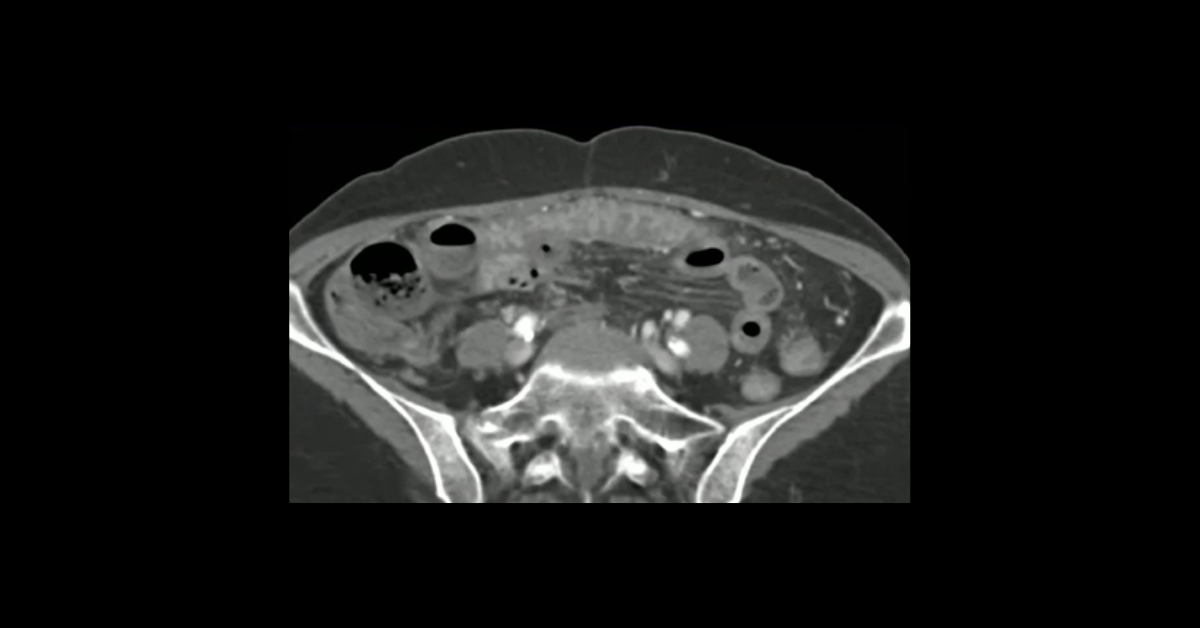 Uncommon Small Bowel Emergencies