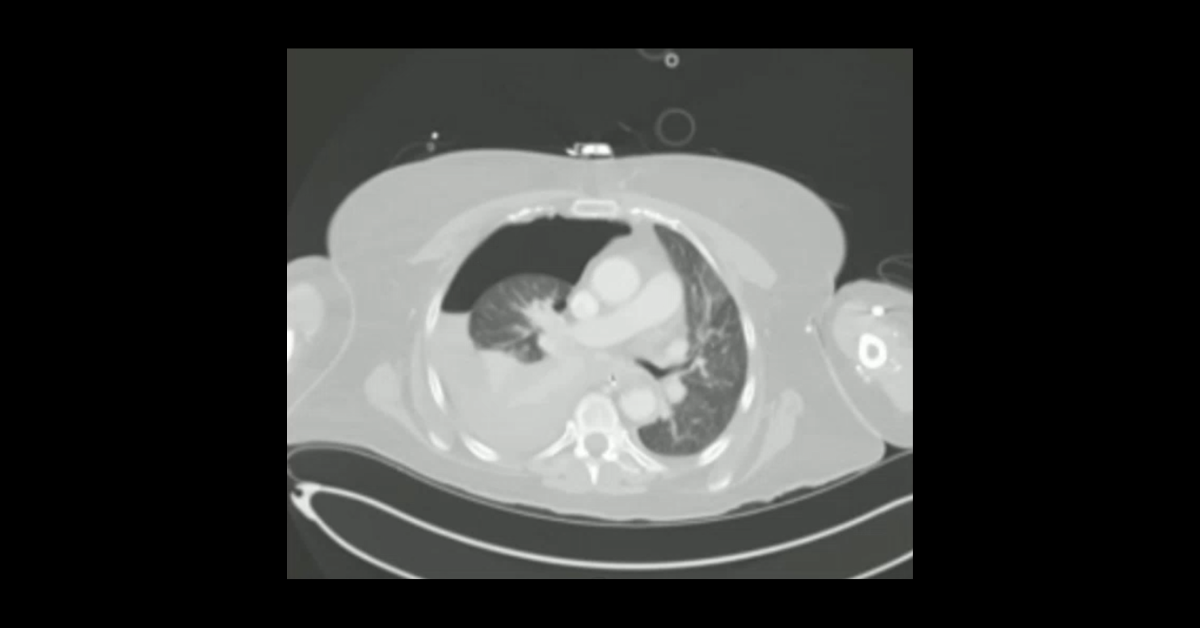 Thoracic Trauma CT Part 3 (Aorta & Bronchi)