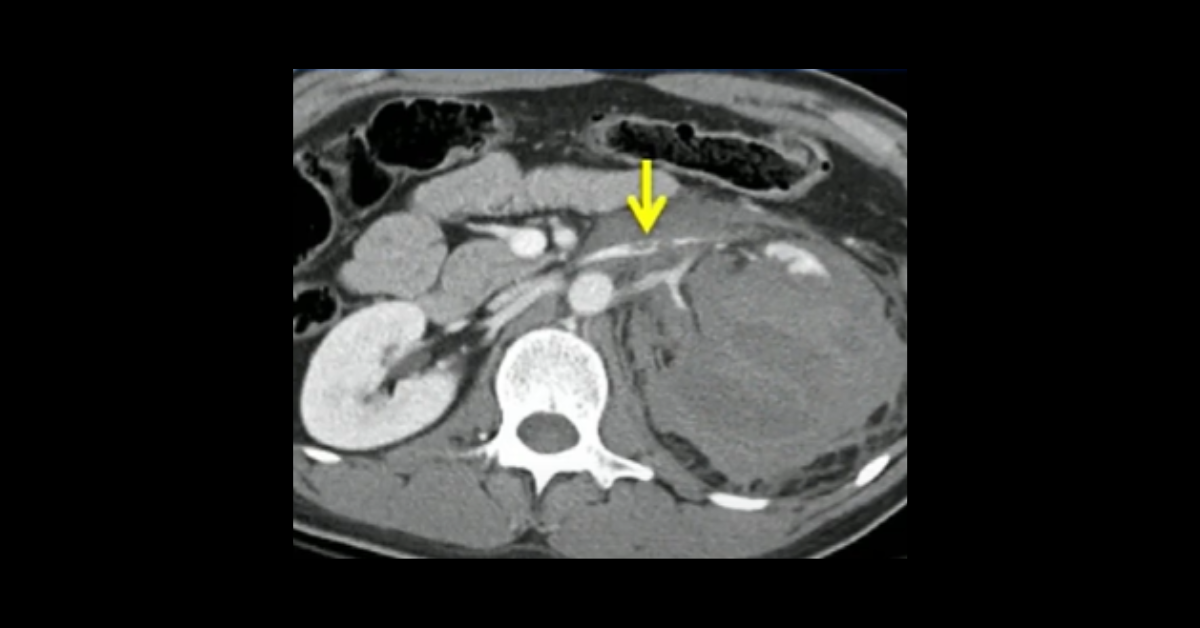 Misses, Misinterpretation & Essentials of GU Trauma
