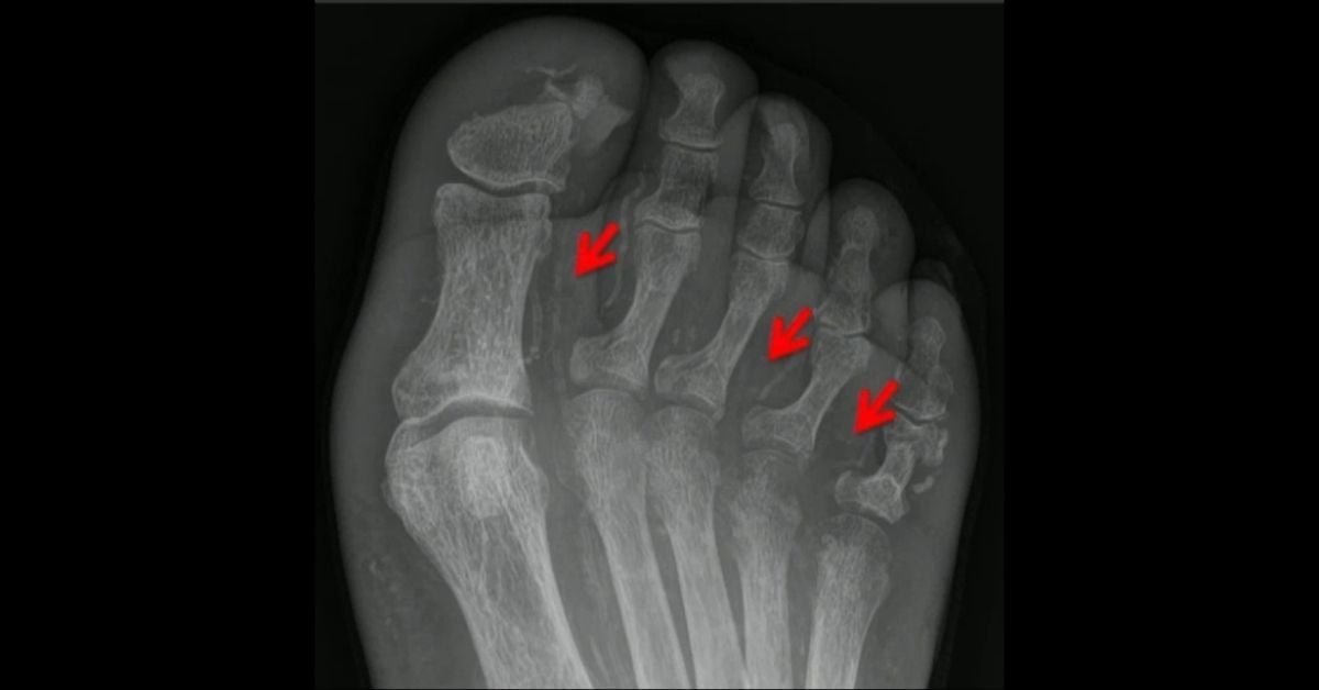 Imaging of Musculoskeletal Infections