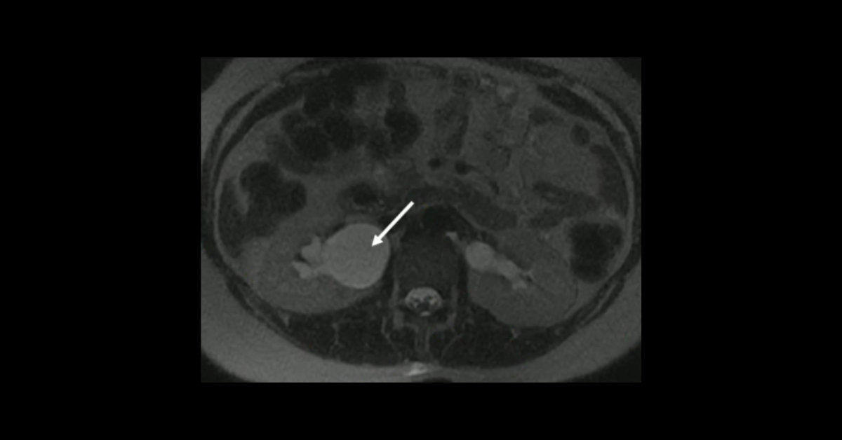 Imaging the Acute Abdomen in Pregnancy