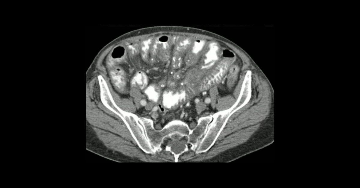 Imaging of Bowel Ischemia