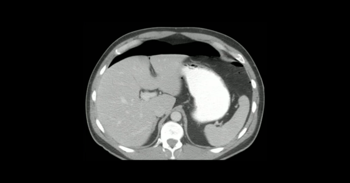 Complications of Bariatric Surgery