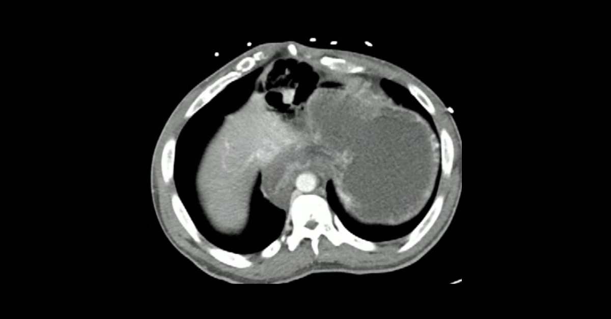 GI Tract Volvulus