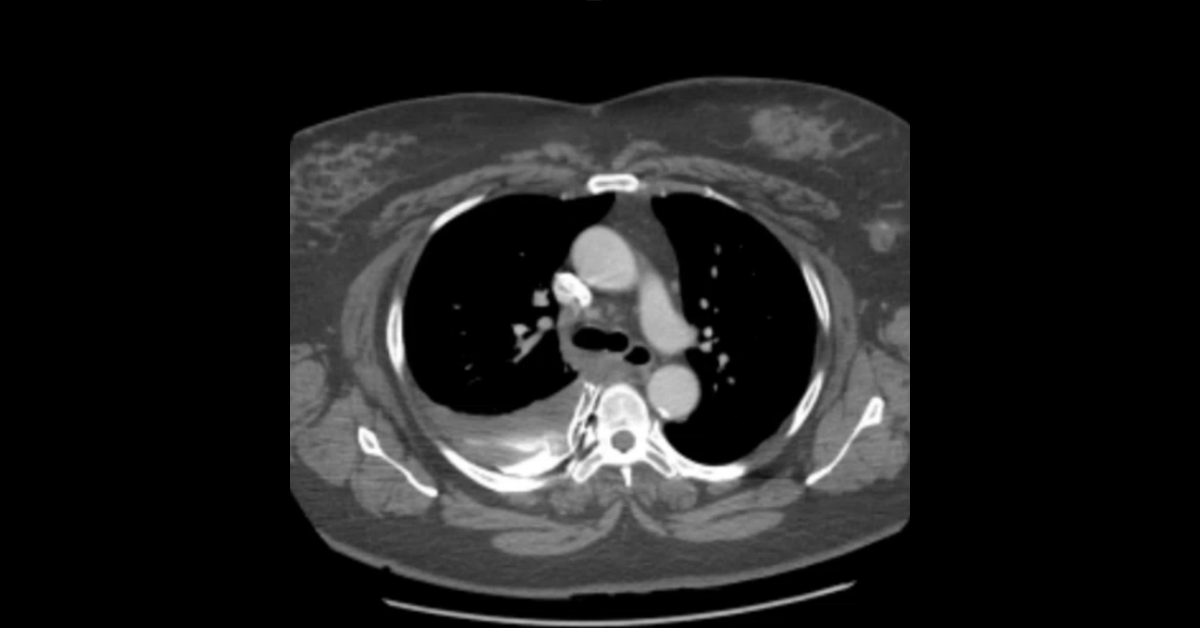 Thoracic Trauma CT Part 4 (Pulmonary & Mediastinal)