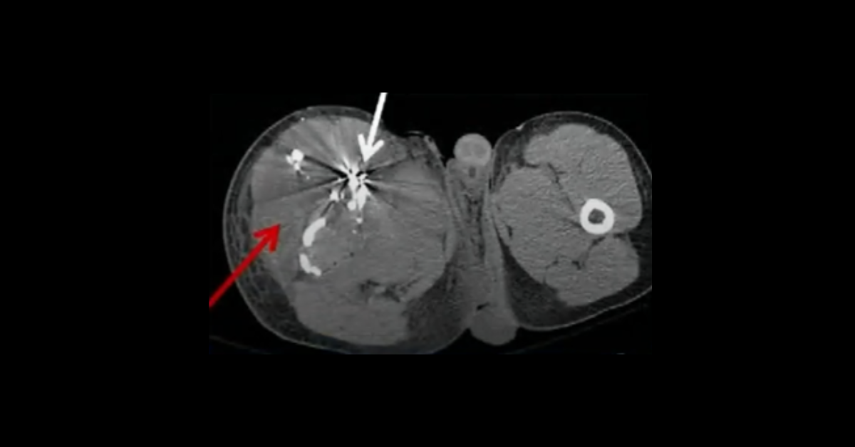 Peripheral Vascular Trauma