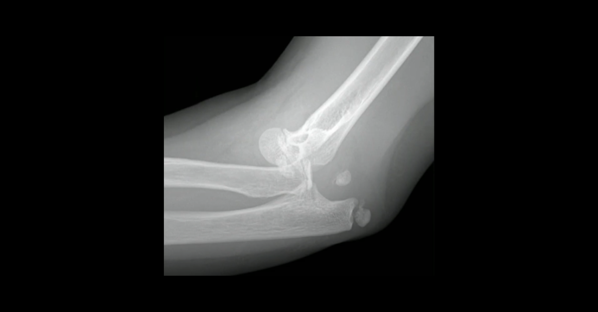 Pediatric Fractures