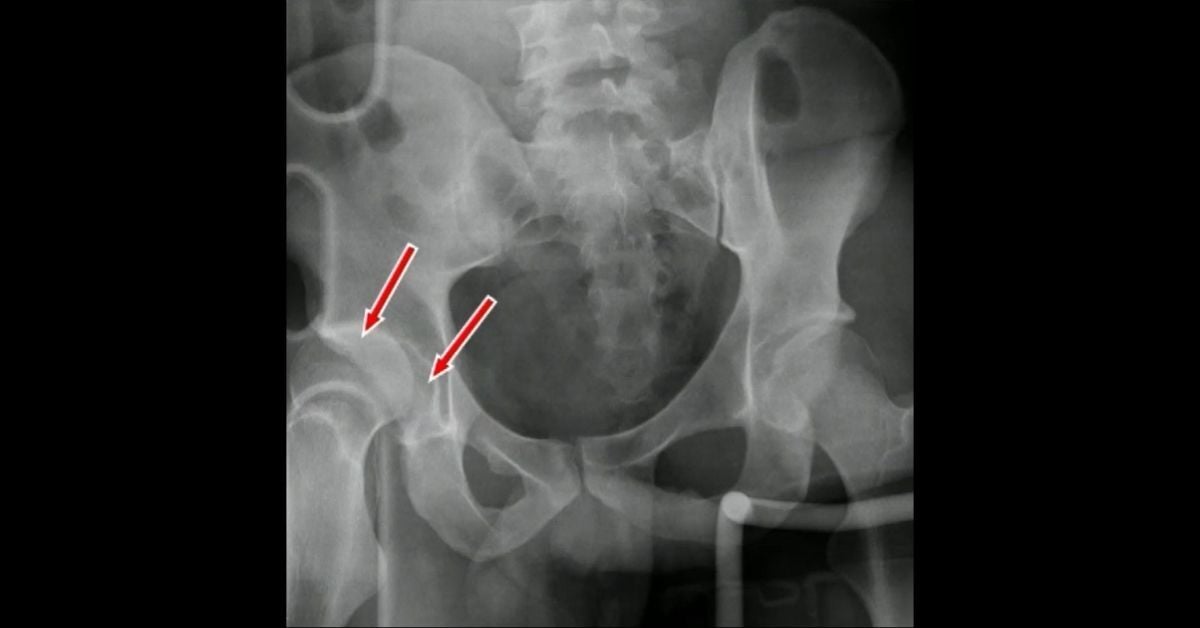 Hip and Peri-Hip Causes of Pain