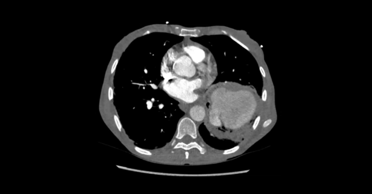 Emergency Pulmonary CT: Part 2