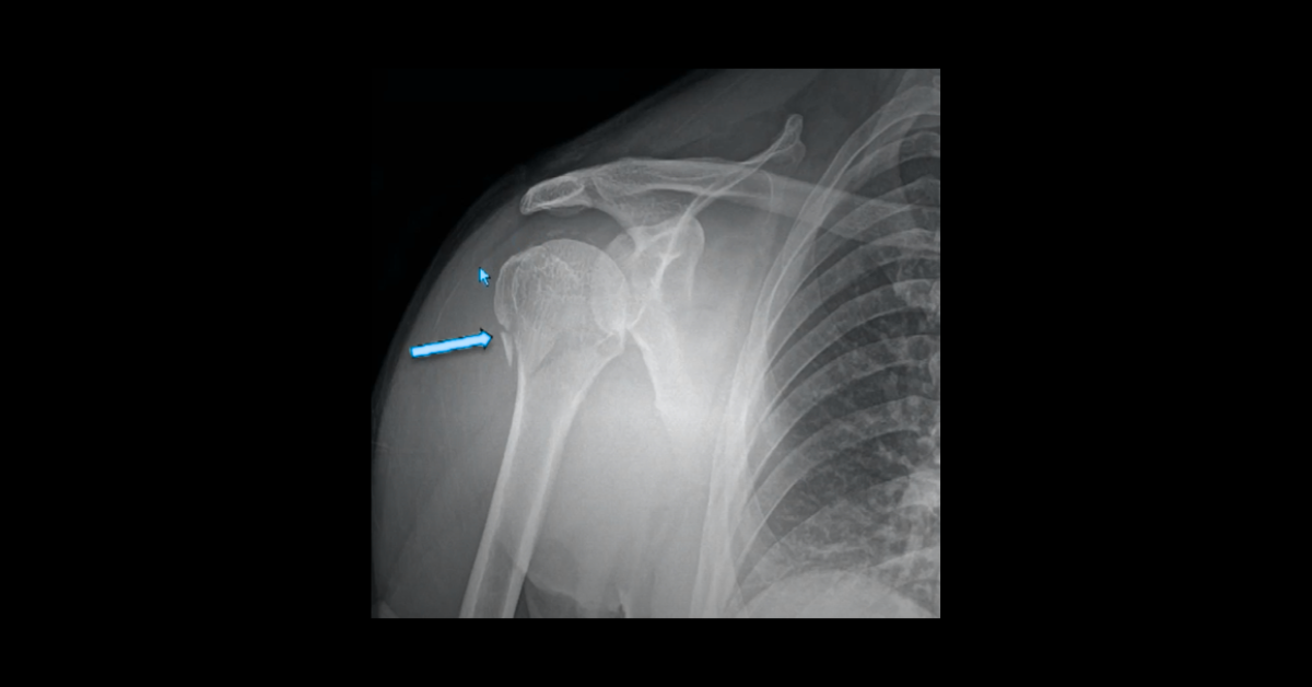 Shoulder Trauma Imaging