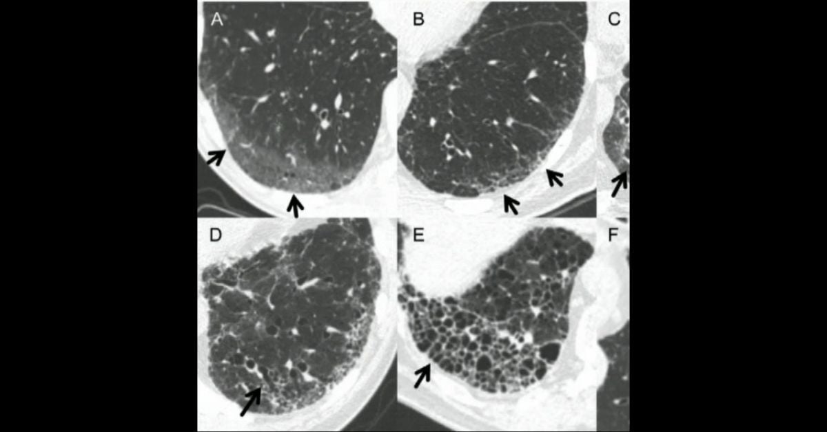 Interstitial Lung Abnormalities