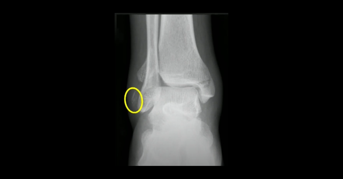 Ankle Trauma Imaging