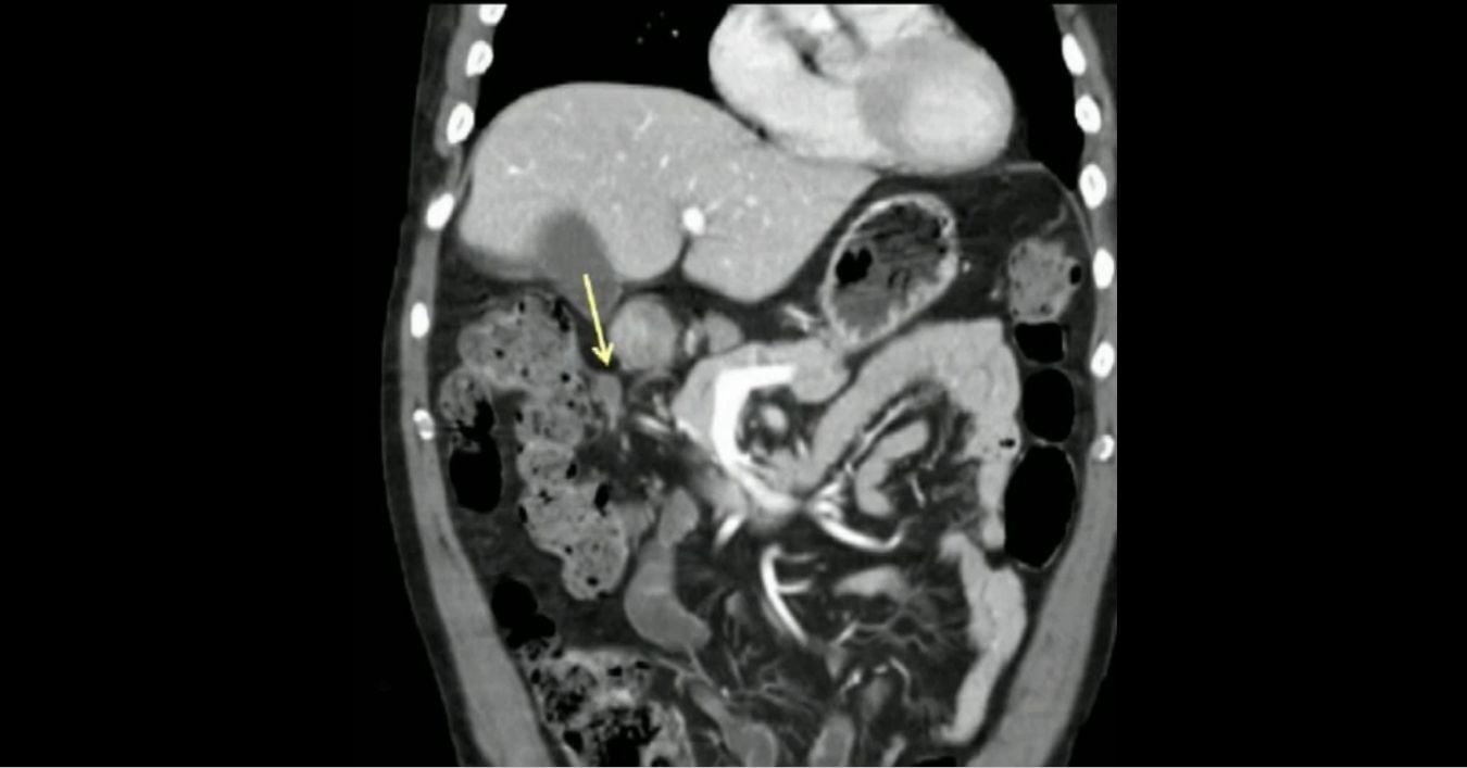 Anatomy of Spaces & Potential Spaces of the Abdomen & Pelvis