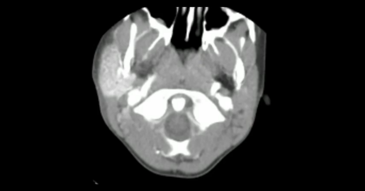 Pediatric Head & Neck CT