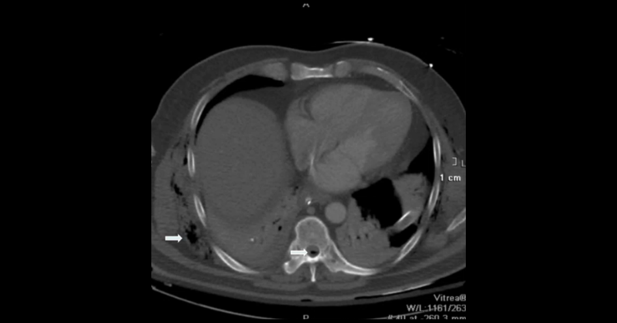 Trauma Complications in Ankylosing Spondylitis