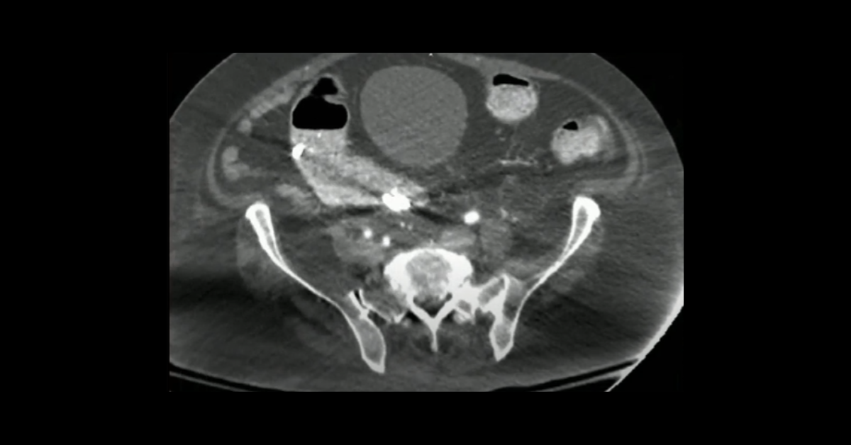 CTA and Runoffs for the Diagnostic Radiologist