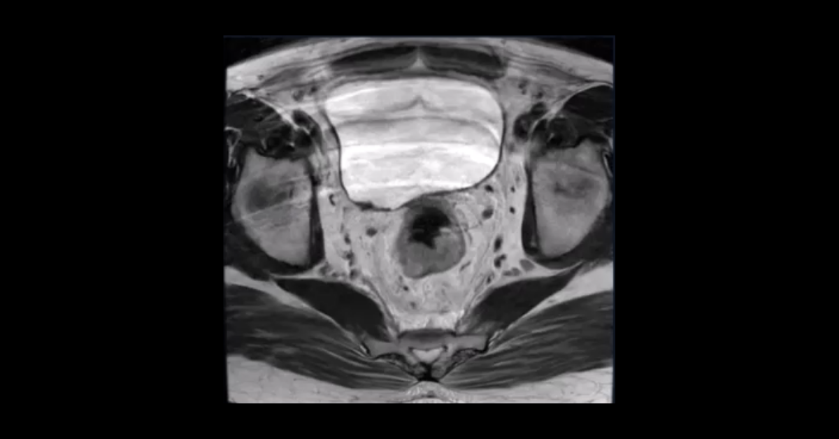 MRI of Rectal Cancer: Initial Staging and Restaging