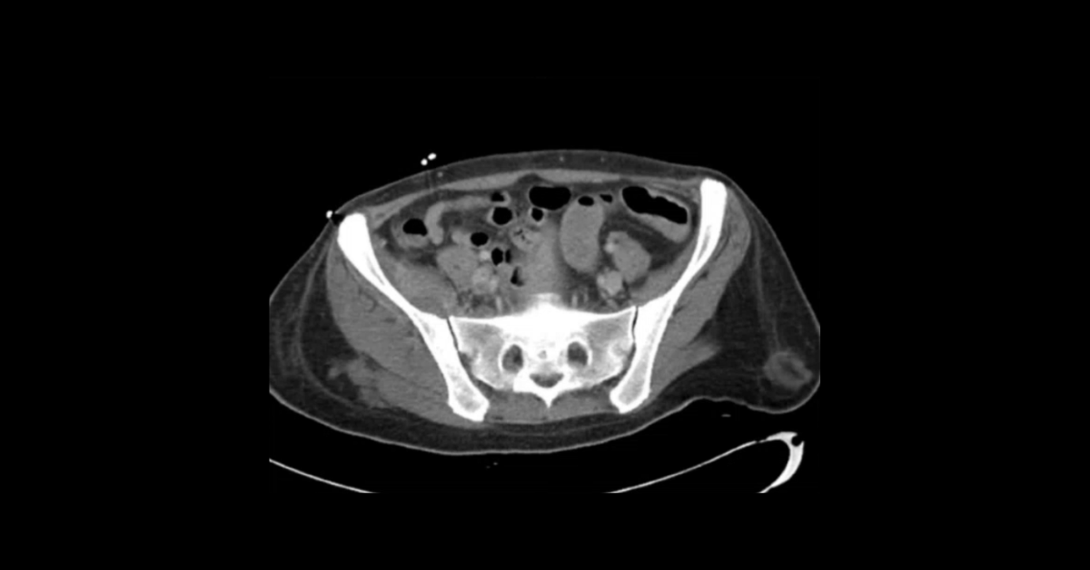 CT of Pulmonary Pathology