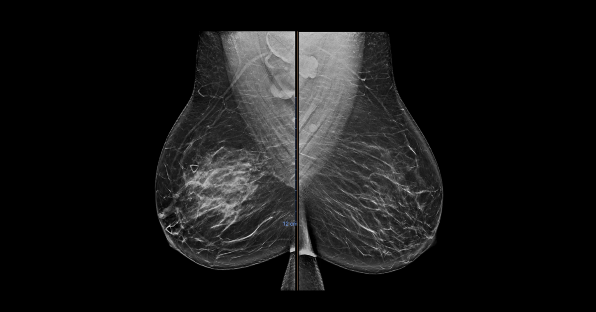 Pediatric Breast Case Review