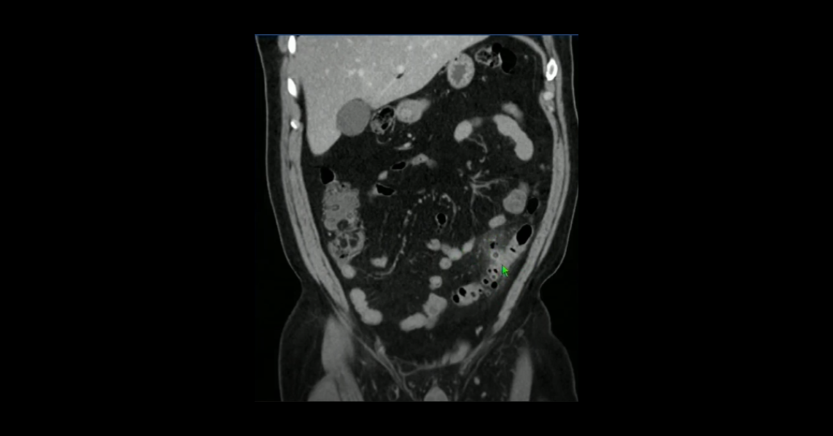 Colonic Emergencies